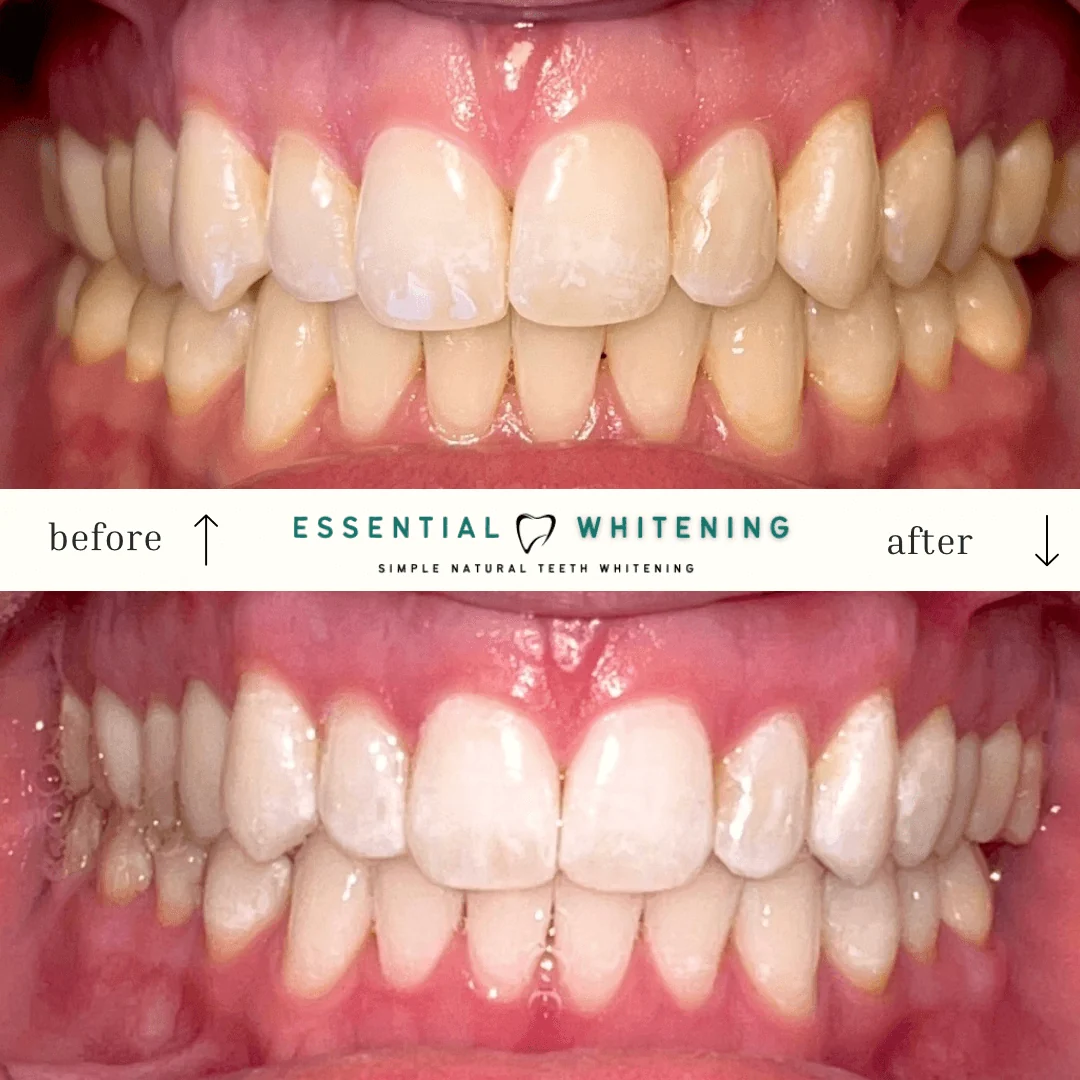 Essential Whitening before and after result 1