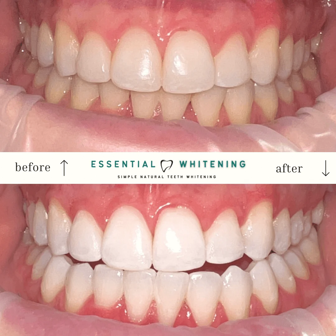 Essential Whitening before and after result 2