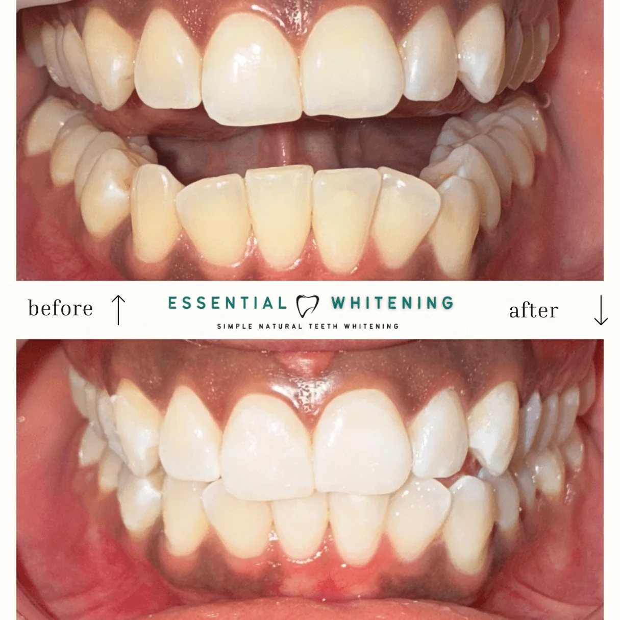 Essential Whitening before and after result 6