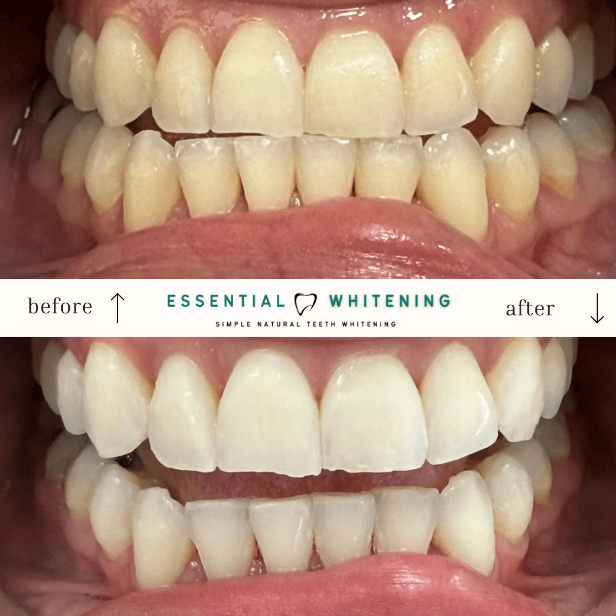 Essential Whitening before and after result 10