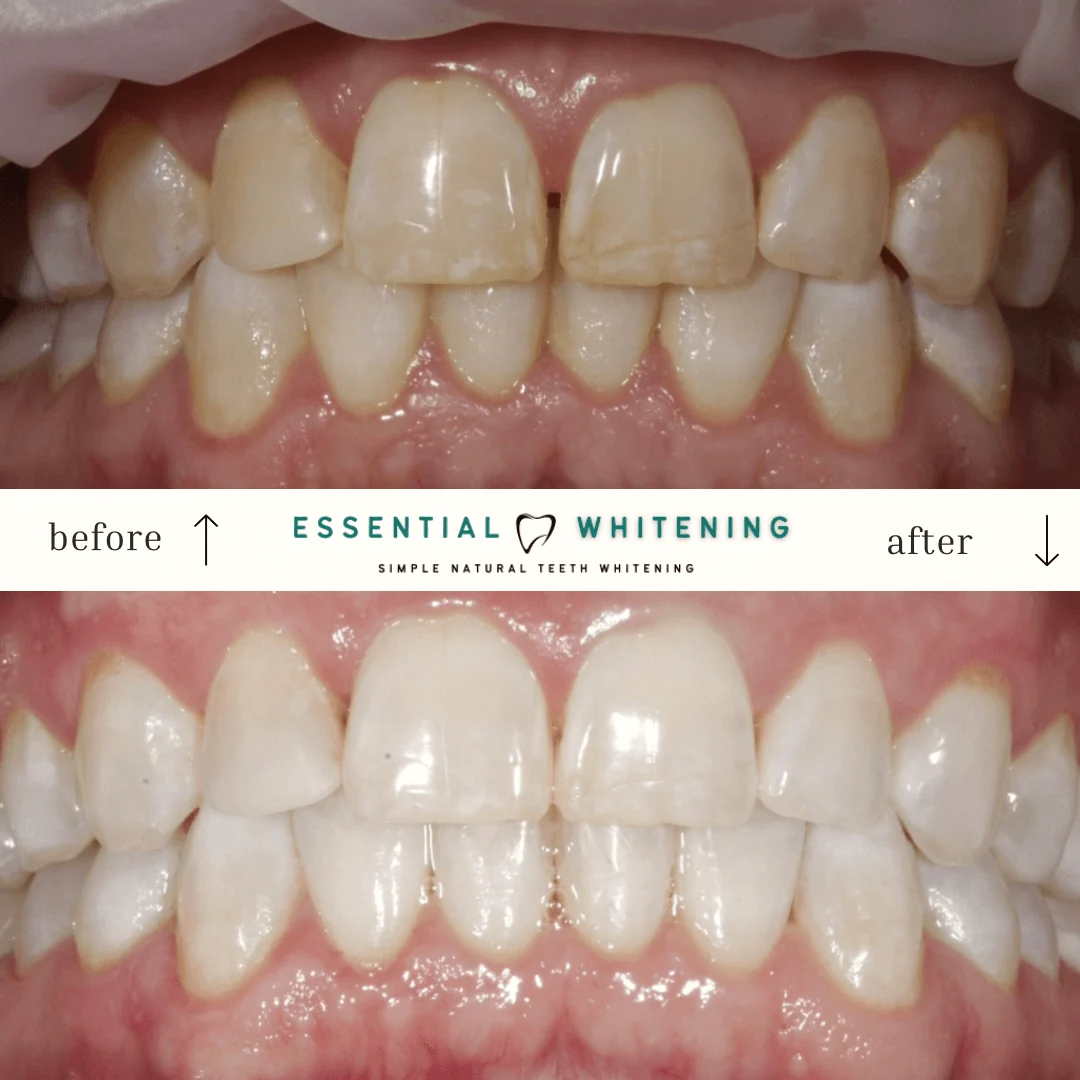 Essential Whitening before and after result 5