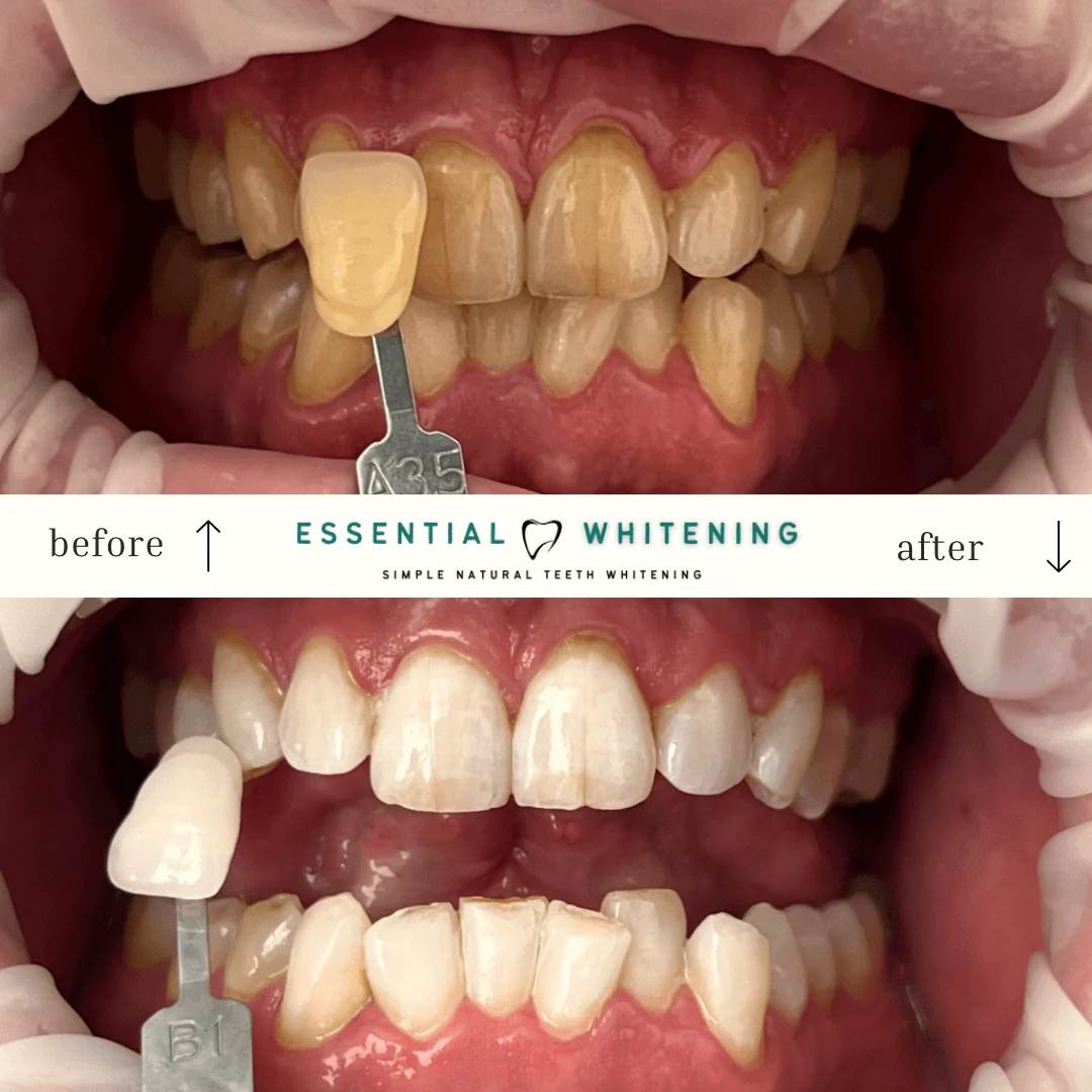 Essential Whitening before and after result 4