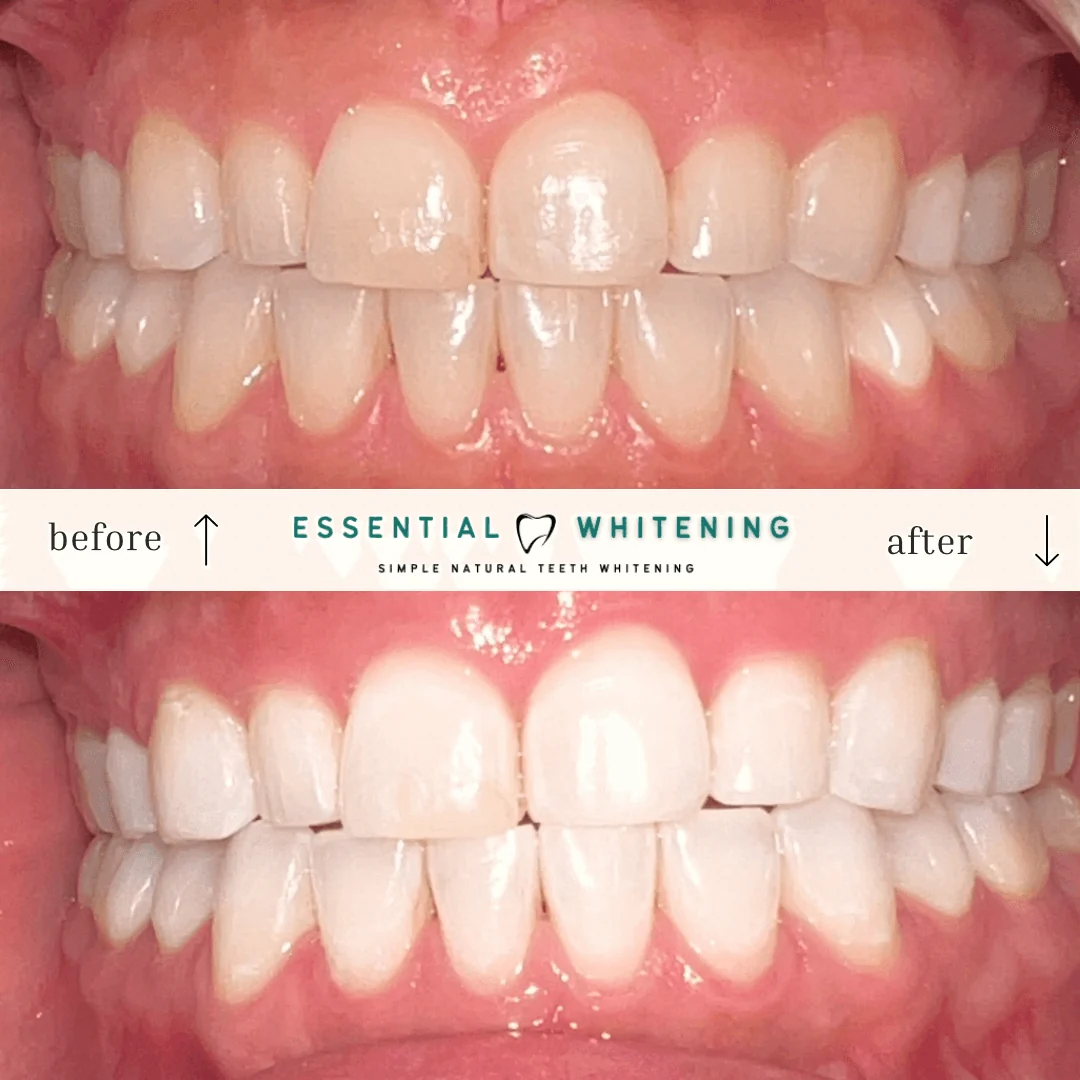 Essential Whitening before and after result 3