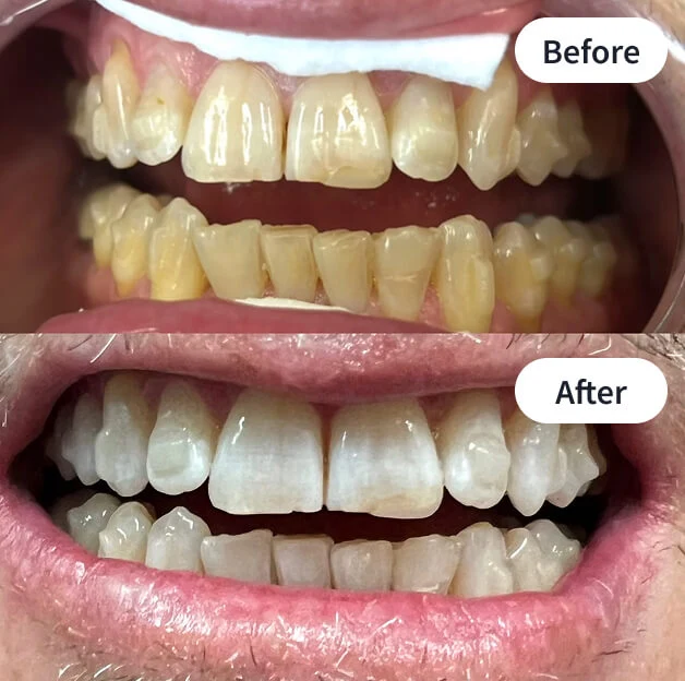 Essential Whitening before and after result 12