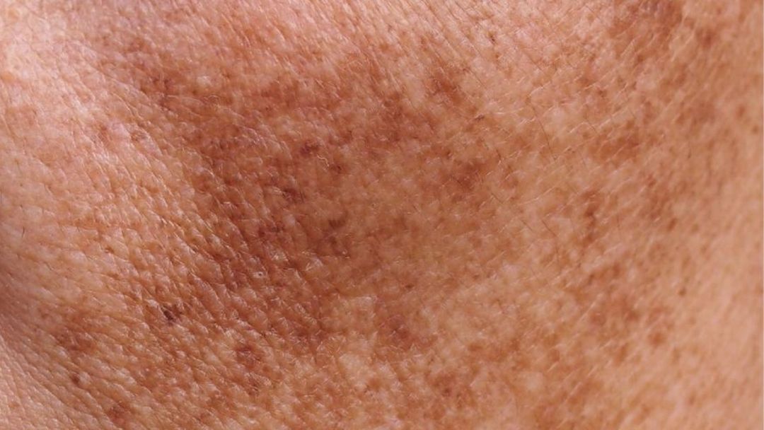 Sun Spots (Solar Lentigines)