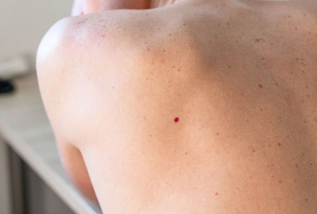 Cherry Angioma