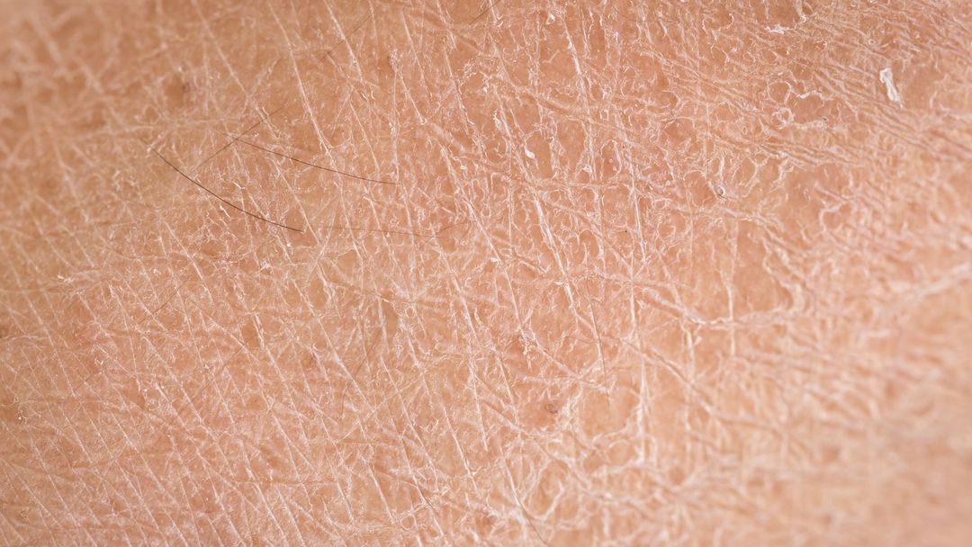 Dry Skin (Xerosis)