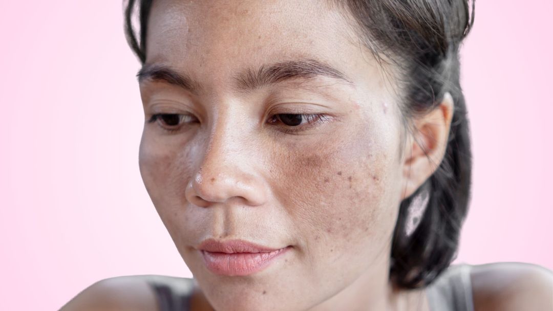 Hyperpigmentation