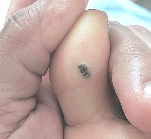 HPV