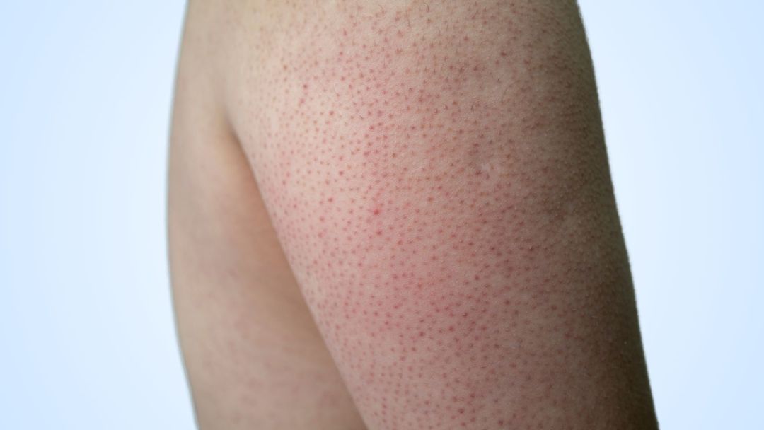 Upper arm skin covered in small rough bumps.
