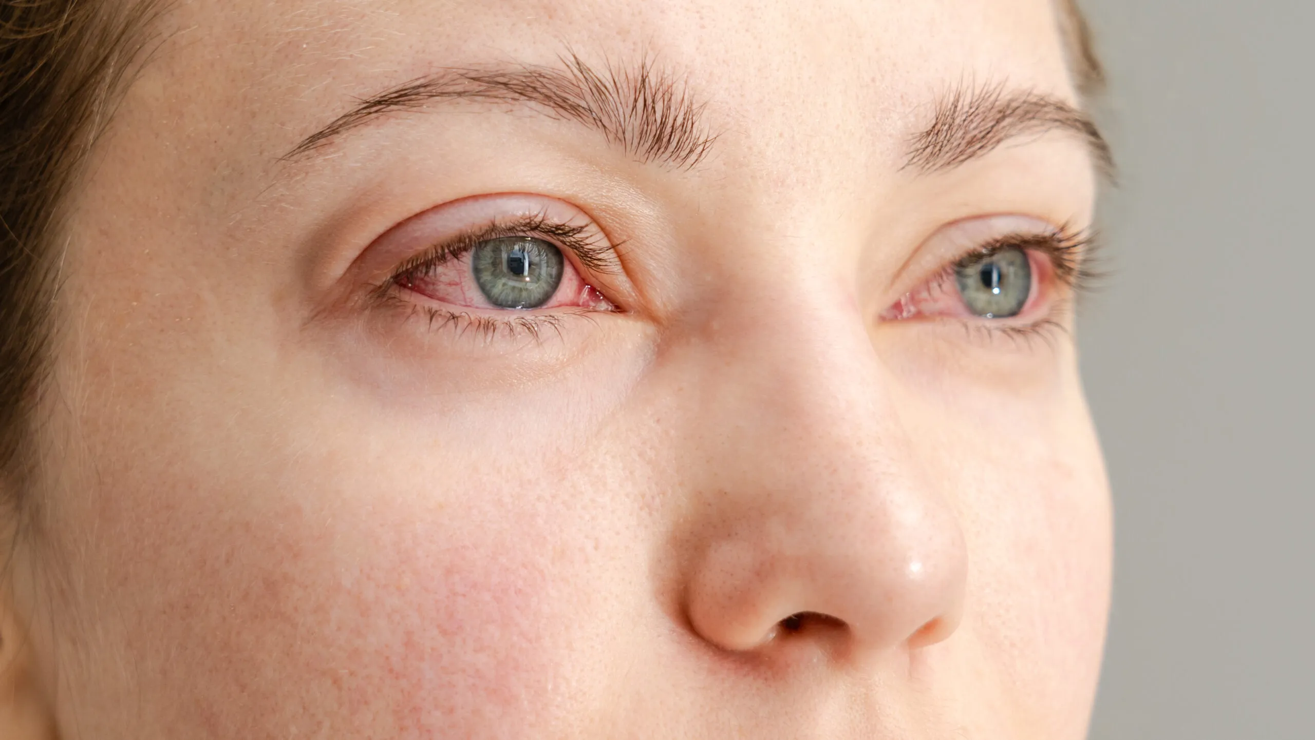 Close-up image illustrating ocular inflammation