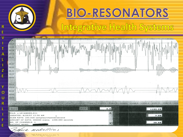 EEG readout before the session showing erratic brain waves