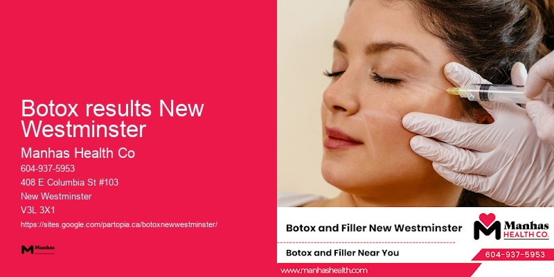 Botox results New Westminster