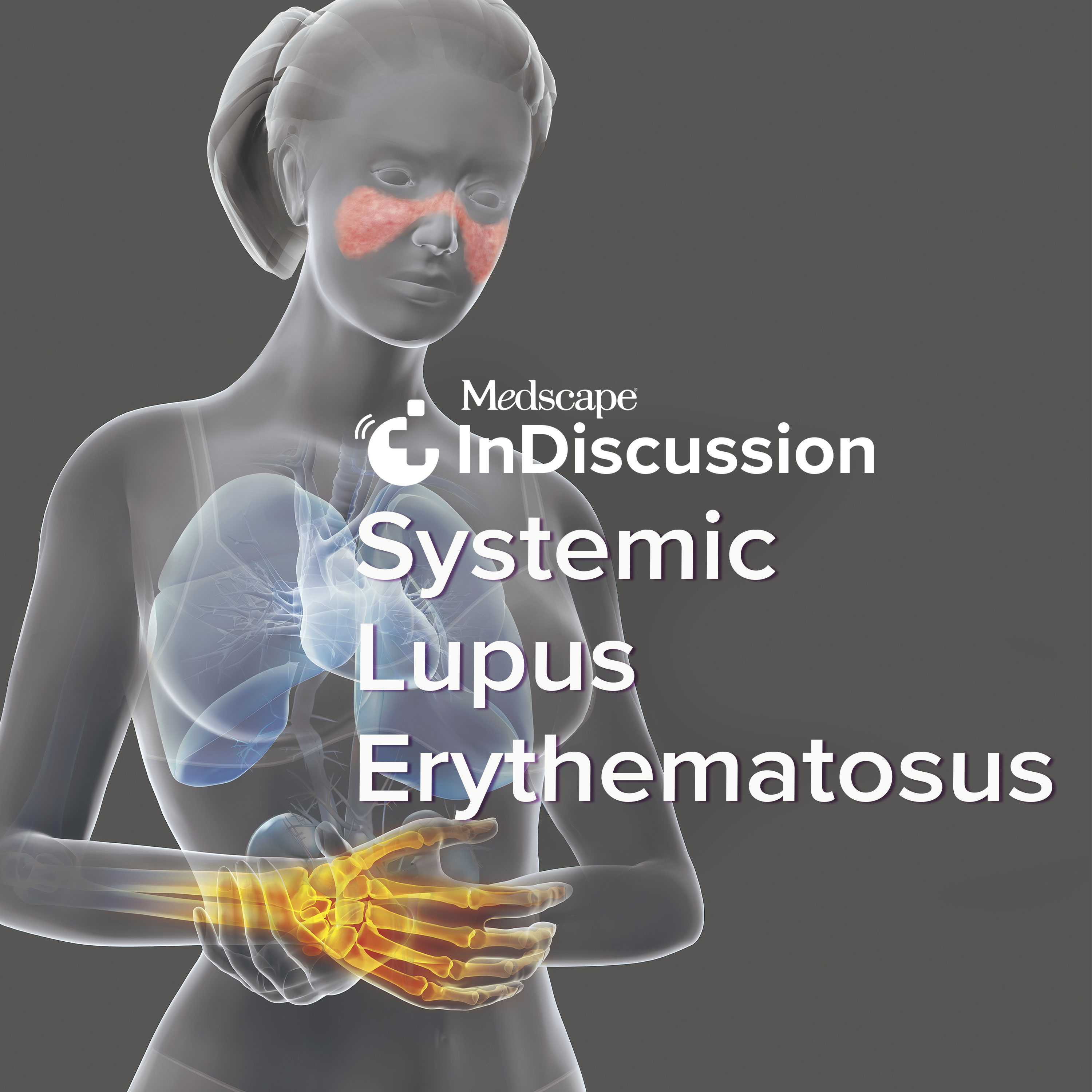 Medscape InDiscussion: Systemic Lupus Erythematosus