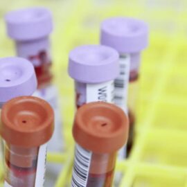 What Causes Cancer Cells? Natural & Unnatural Links