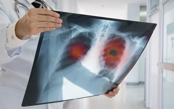 Doctor holding up a chest X-ray showing highlighted areas in both lungs indicating possible tumors.