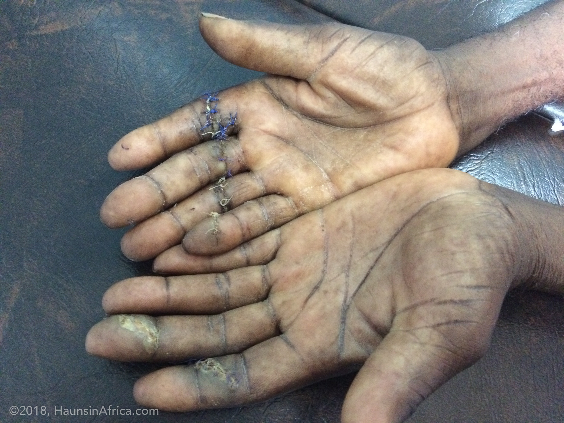 Hand Tendon Injuries and Repair The Hauns in Africa