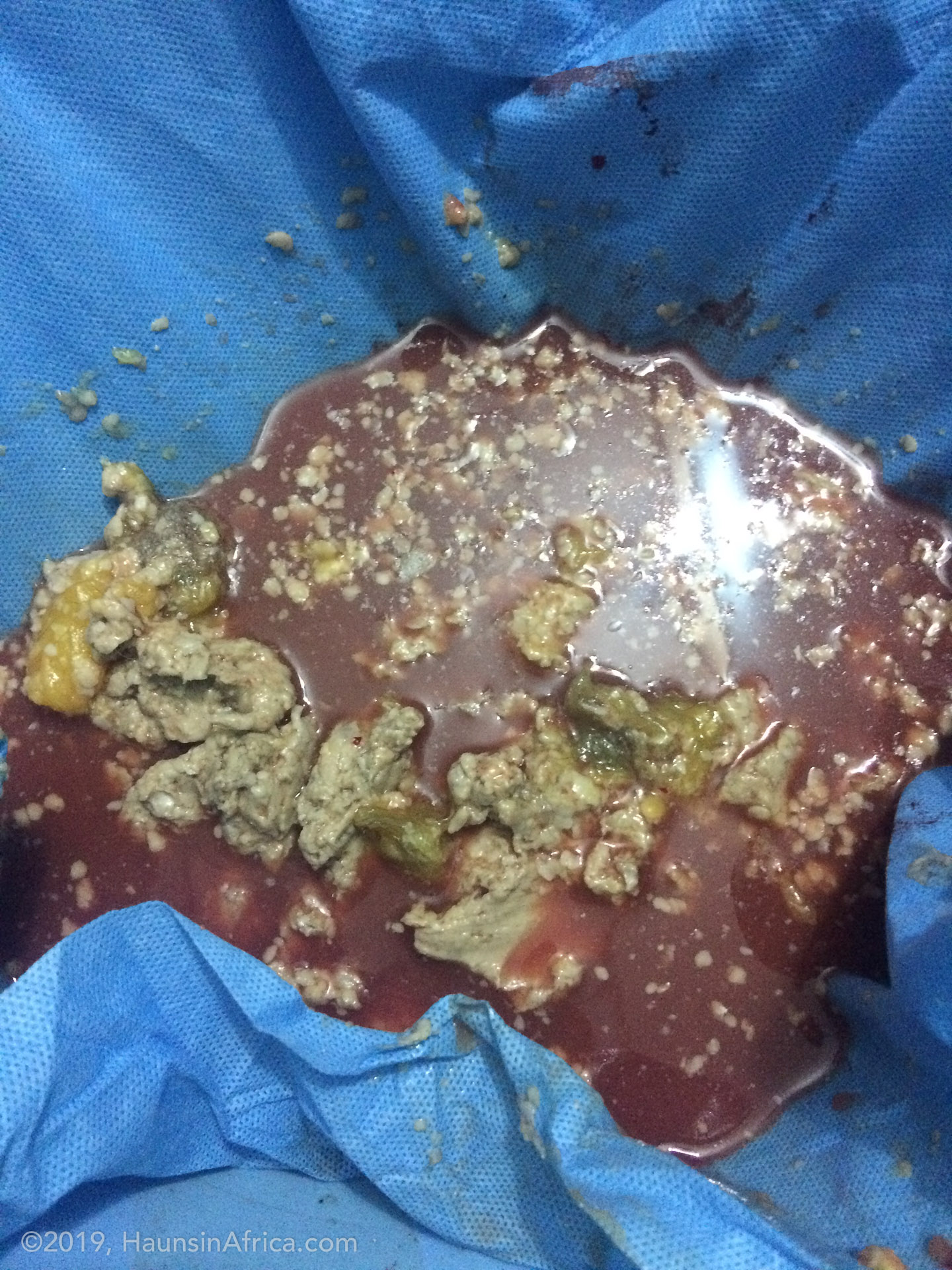 Dermoid Ovarian Cyst - The Hauns in Africa