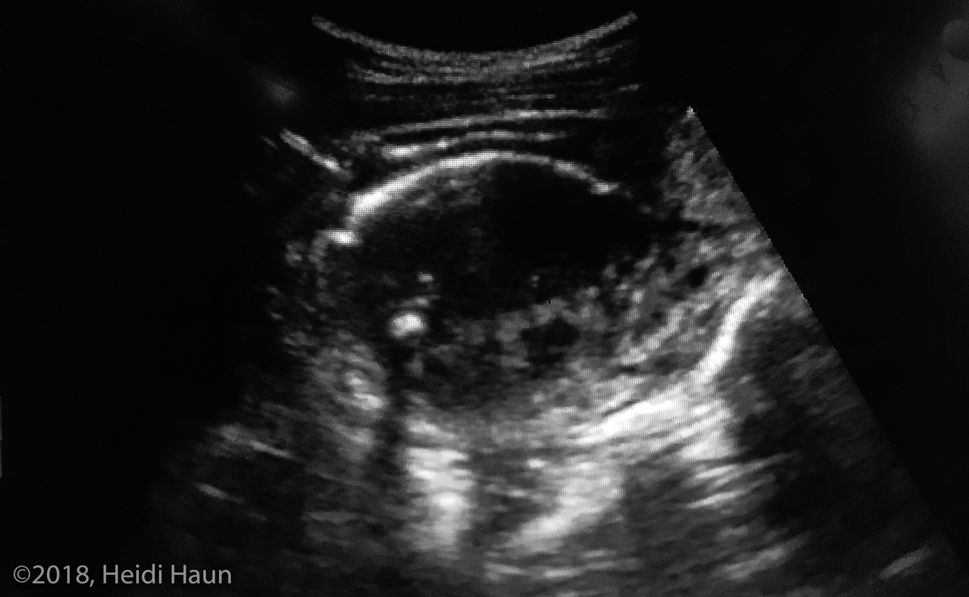 Appendix Ultrasound