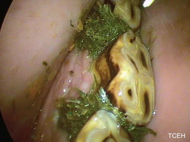 Diastema food packing