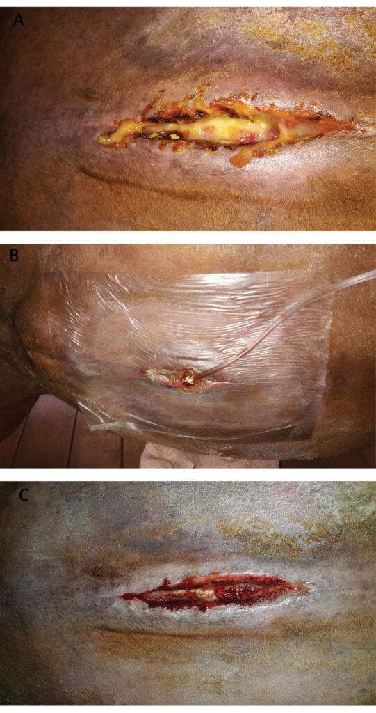 A) An infected laparotomy incision. B) Laparotomy incision treated by negative pressure therapy. C) The laparotomy incision one day after beginning the negative pressure therapy.