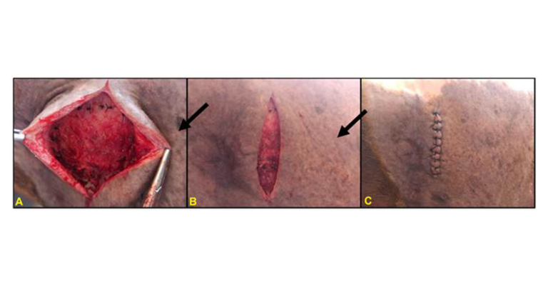 Surgical Mesh