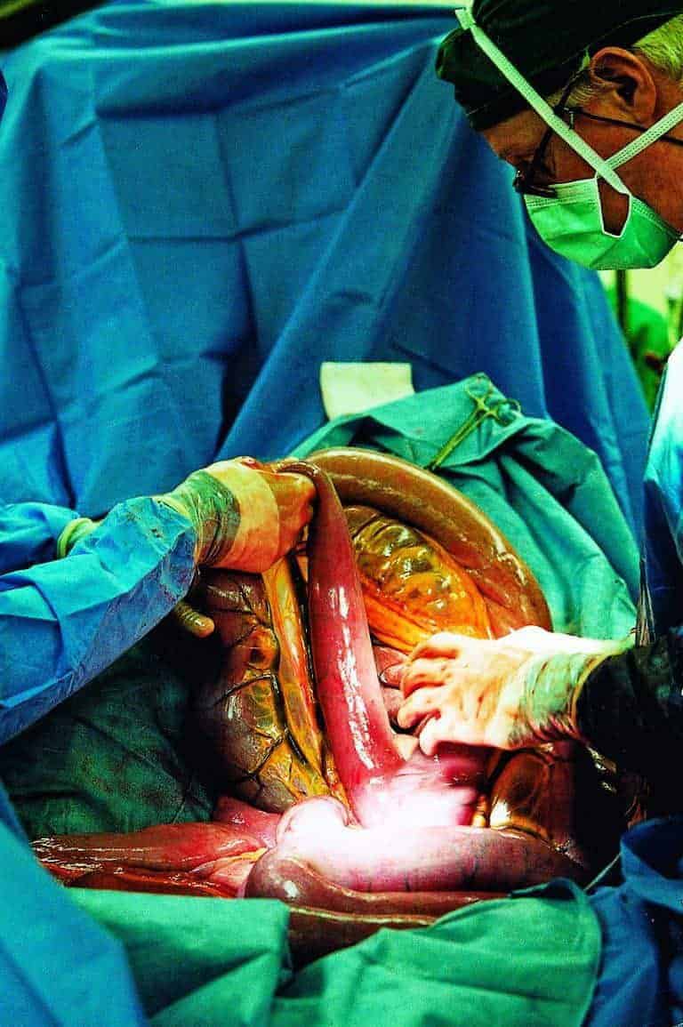 Risk Factors for Colic Surgery Incision Failure Studied