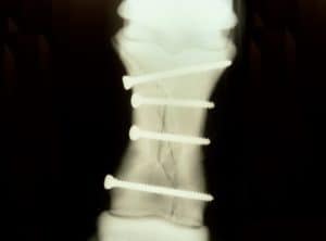 equine fracture managementEquine Fractures: What's Fixable?