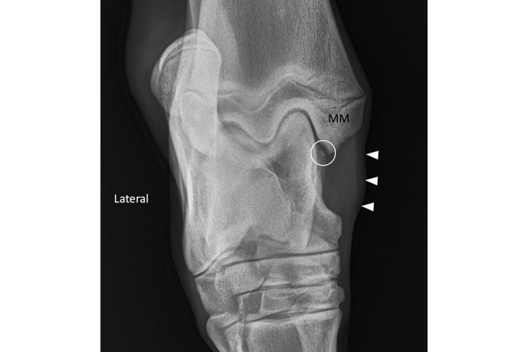 OCD lesion