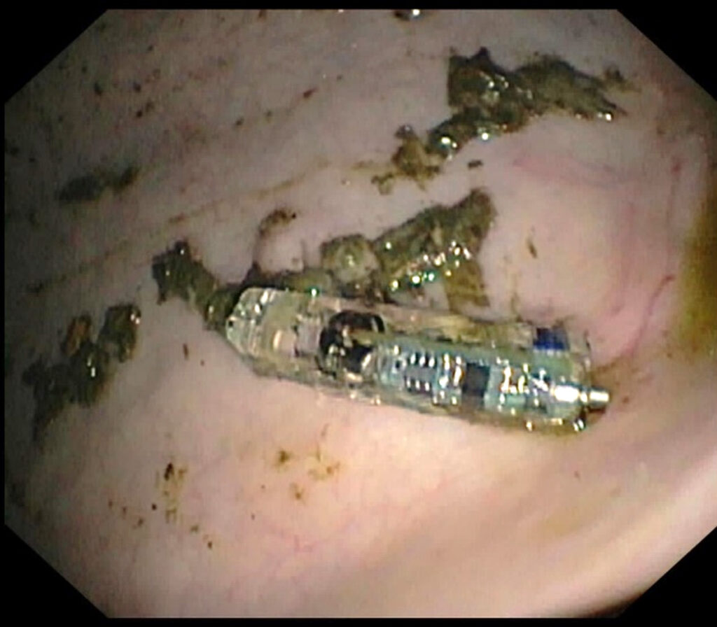 The capsule in the squamous region of the stomach.