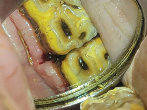 diastema