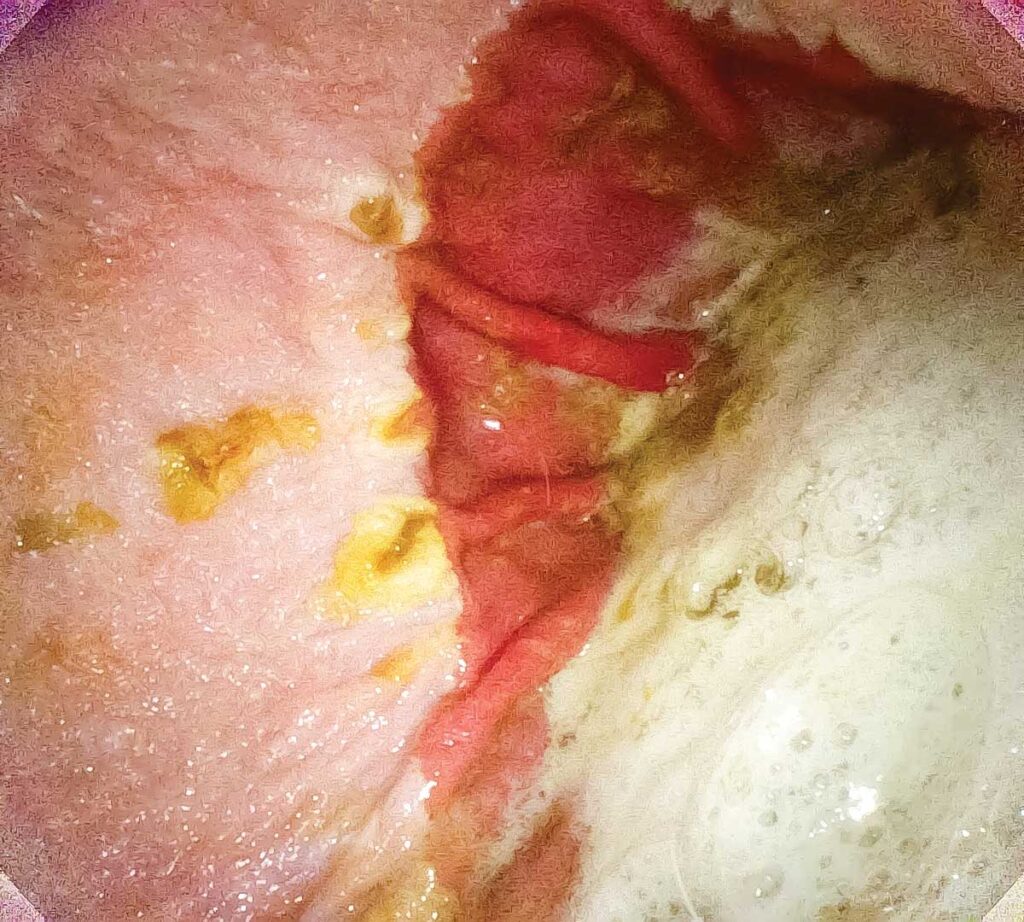 gastric ulcer