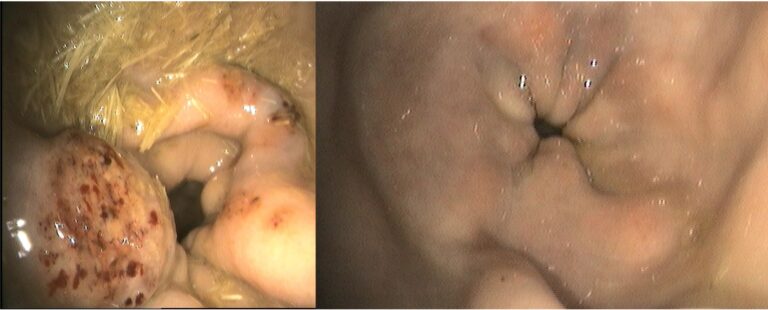 Before-after CGC removal