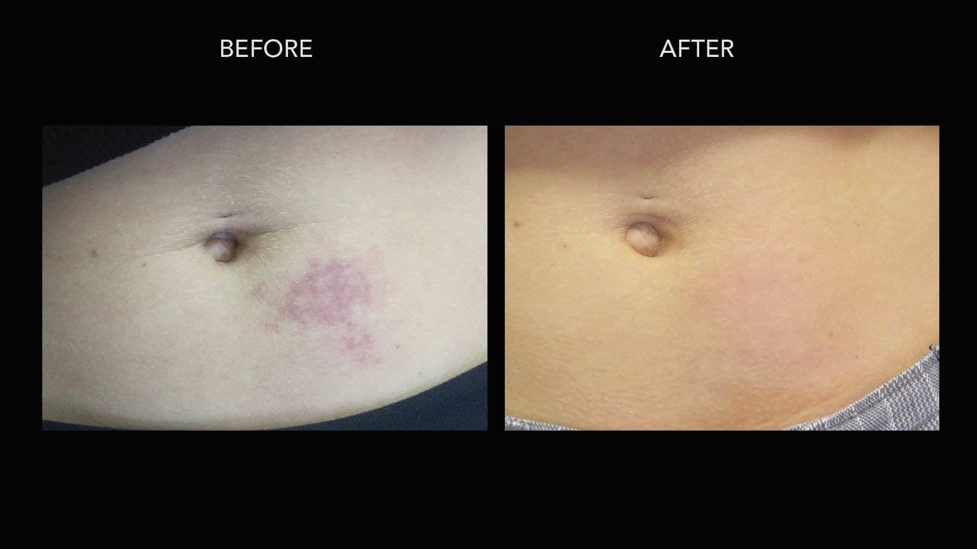V Beam before and after photo of a birthmark treatment by Dr. Umar.*