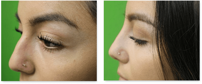 15 minute nose job before and after Non surgical nose job before and after