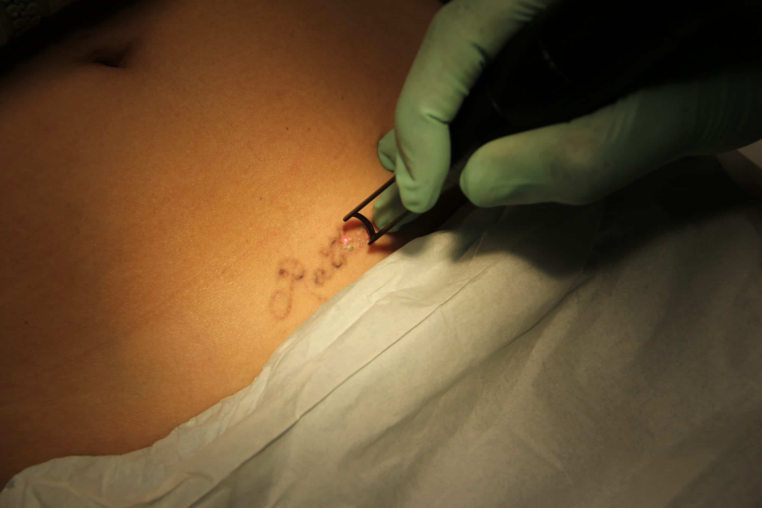 Dr. Umar uses a YAG laser over the course of several sessions to remove the tattoo. 