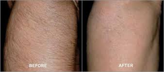 Before and after photo of a patient who received laser hair removal for his upper arm.