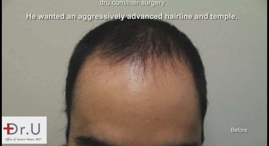 The patient experienced a receding hairline and loss of temple coverage before seeing Dr. Umar