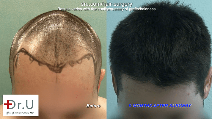 Photo shows area of onset of Hair Loss After Hair Transplant. 
