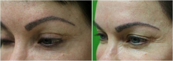Before and after eyebrow hair transplant with Dr. Umar