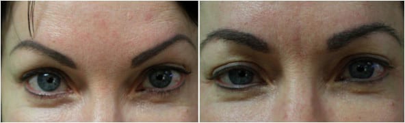 Hair transplant for eyebrows: Before and after eyebrow graft