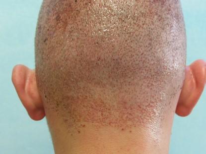 Hair restoration FUE: Follicular unit extraction process has quick healing time