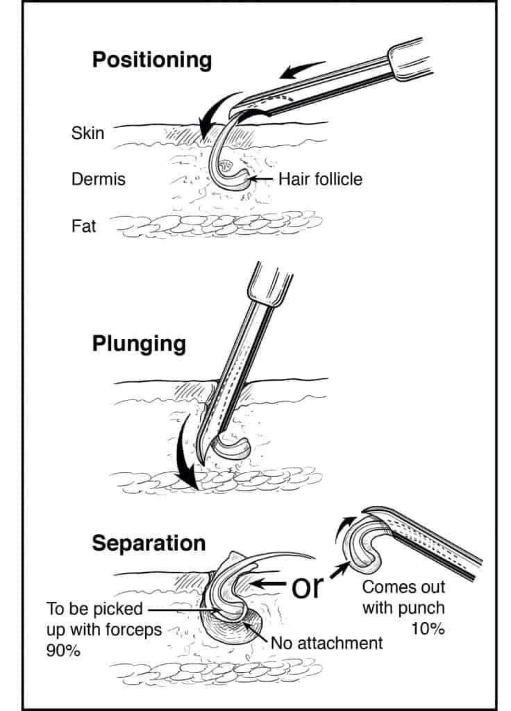 The Dr.UPunch Curl allows for African American hair restoration