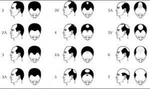 norwood-scale - Dr U Hair And Skin Clinic