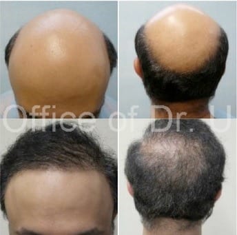 8,000 BHT restores full head of hair using Advanced FUE hair restoration.