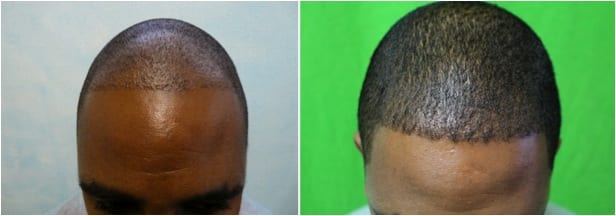 After failing basic FUE in another clinic, this African haired patient found solution with Dr.UGraft FUE by Dr U