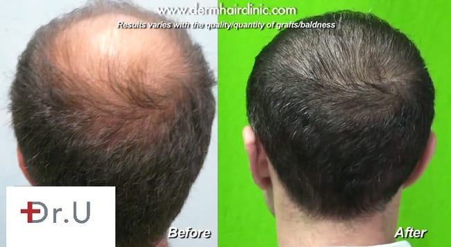Dr. Umar performed a hair transplant for the crown on this patient by expanding the donor pool to include grafts from the beard area