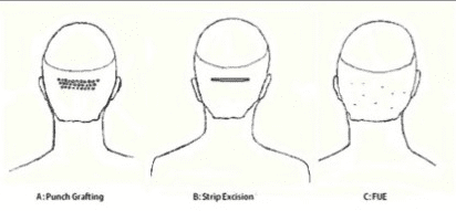 Different hair transplant processes and their incision patterns including FUE hair restoration
