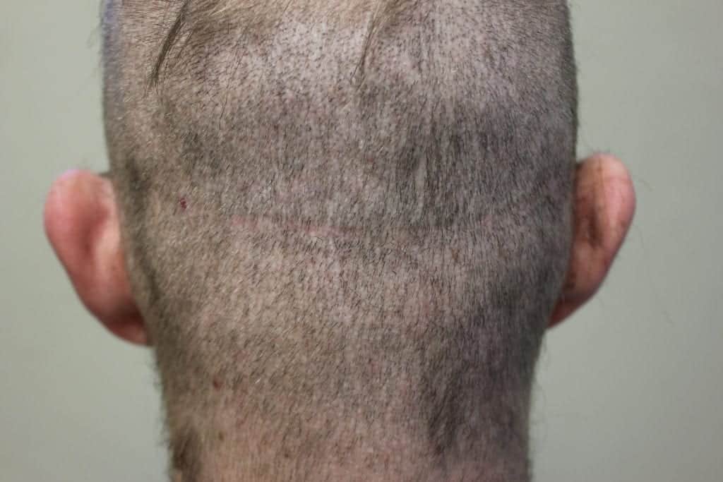 fue white dot scarring in a shaved head vs strip scar in the shaved head of a patient