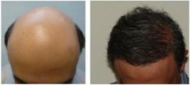 Until Cloning hair follicles becomes a reality, Dr.UGraft methods of head and body transplants offers a way to treat severe hair loss